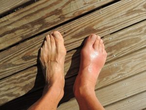 Swollen feet