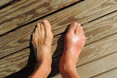 Swollen feet