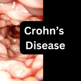 Crohn's disease