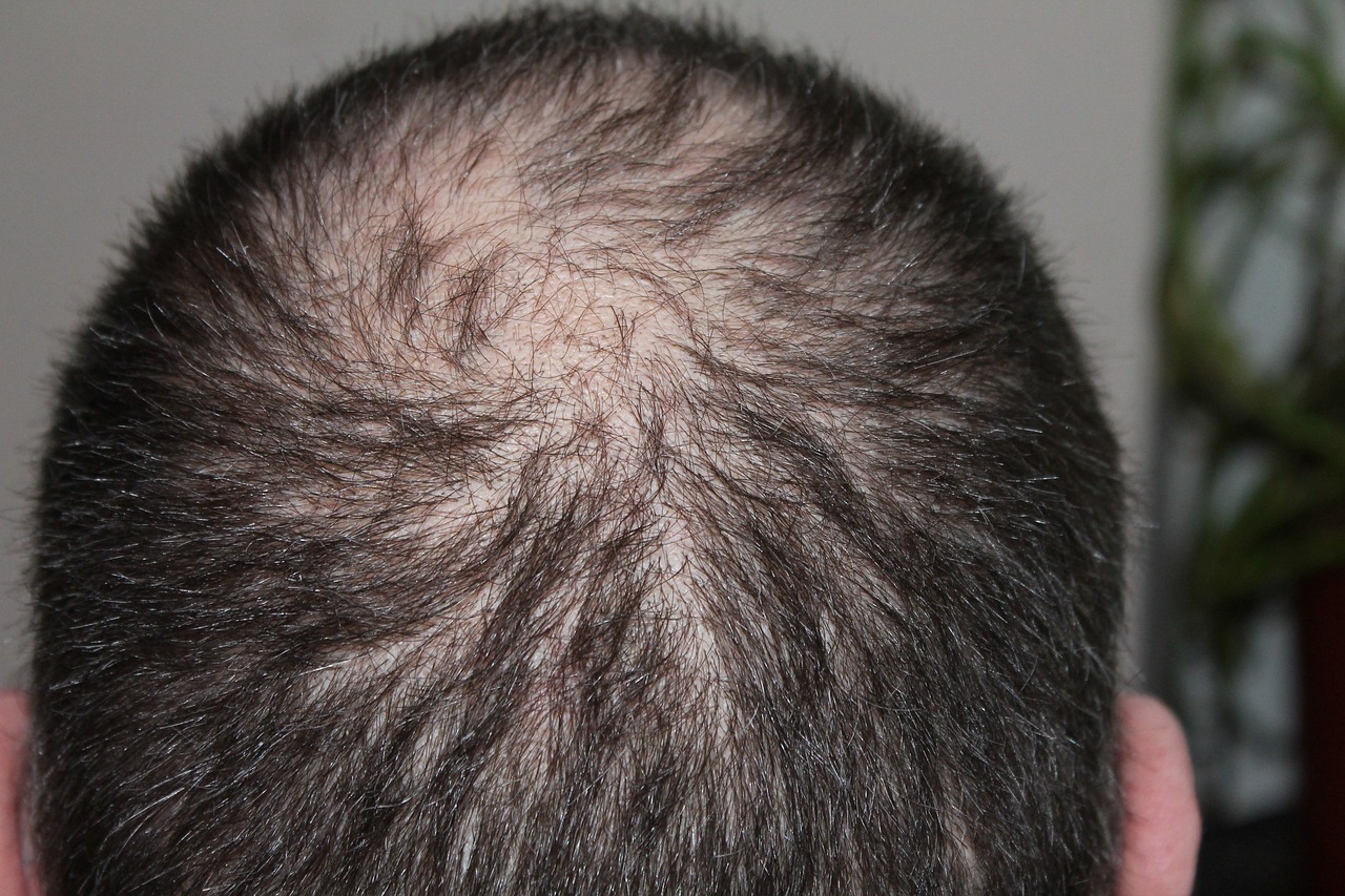 hair loss image